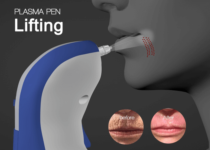 plasma wrinkle removal