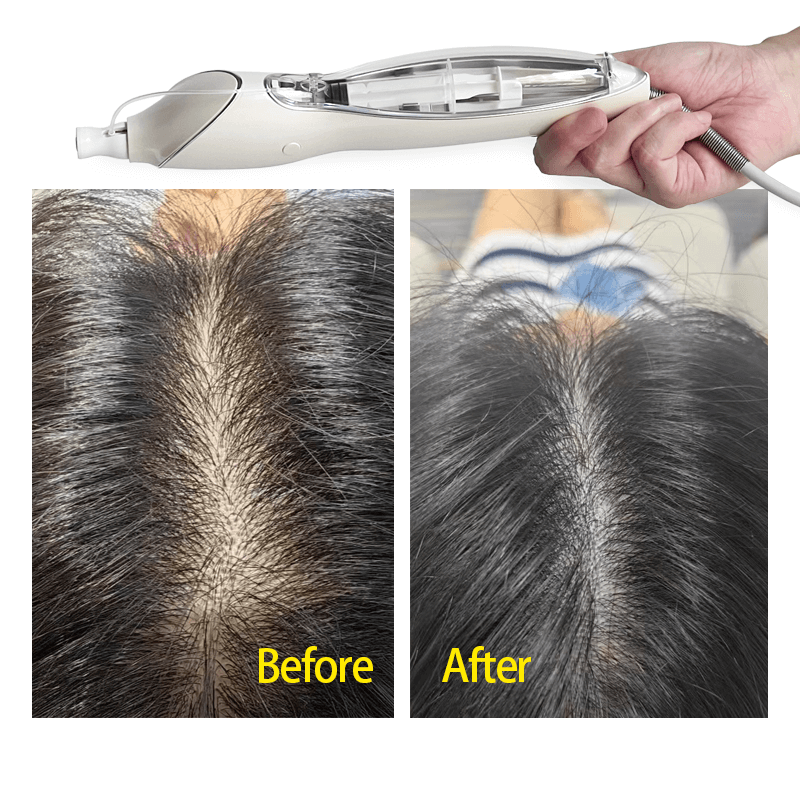 hair scalp injection