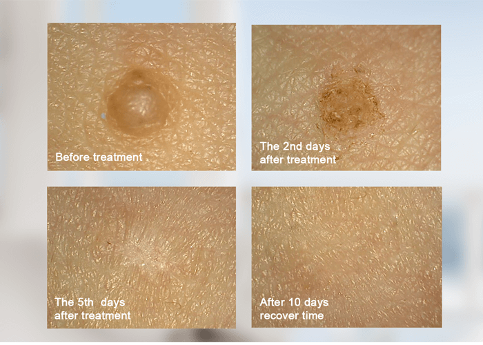 mole dot removal