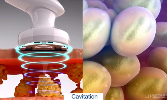 vacuum cellulite machine
