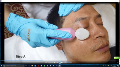 RF eyes wrinkle removal factory