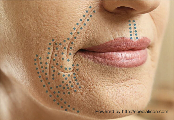 RF fracxtional plasma lift intrtoduce