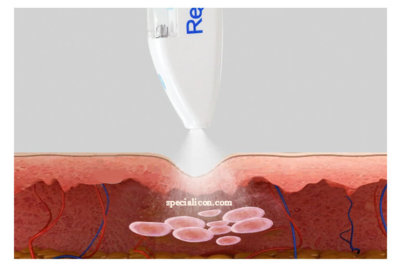 mesotherapy