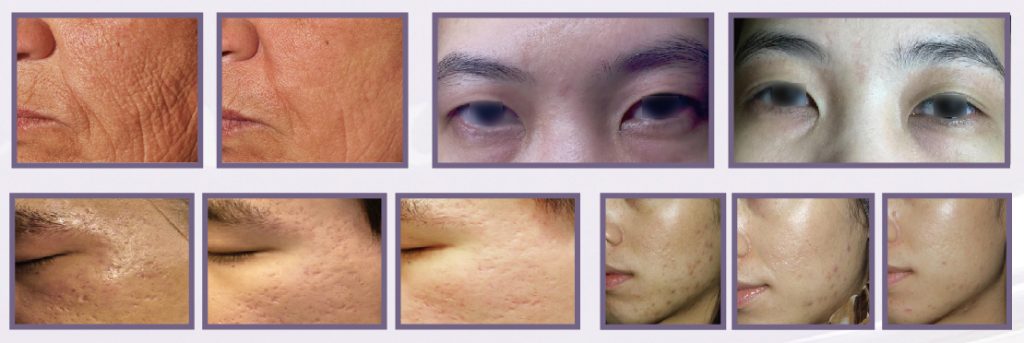 fractional plasma