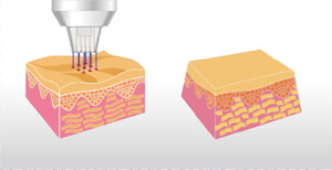 fractional plasma
