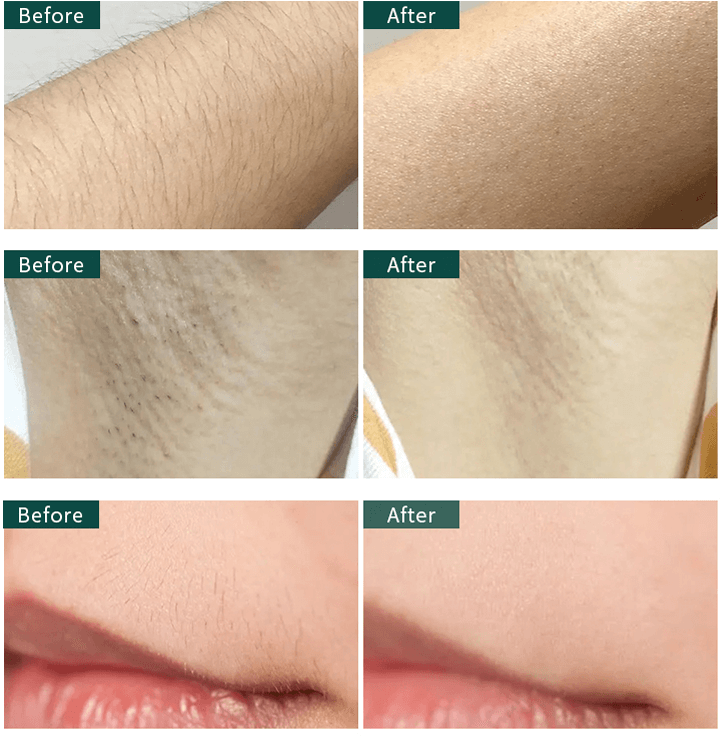 hair removal diode laser