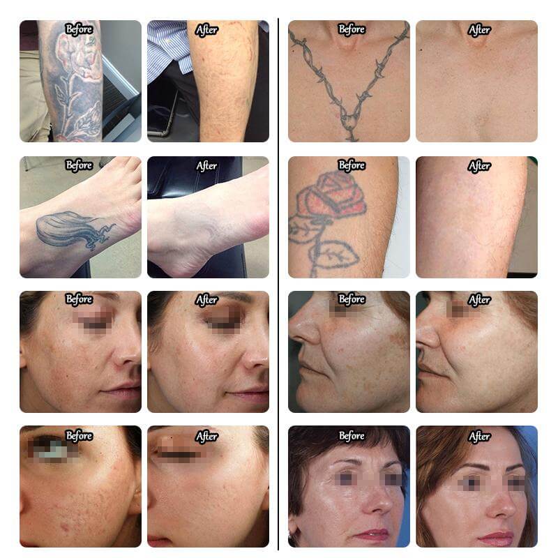 picosure laser