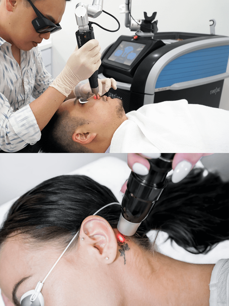 pico laser