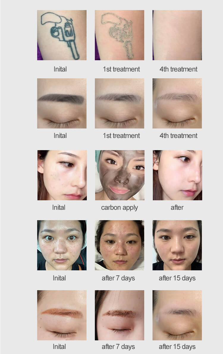 ND yag laser