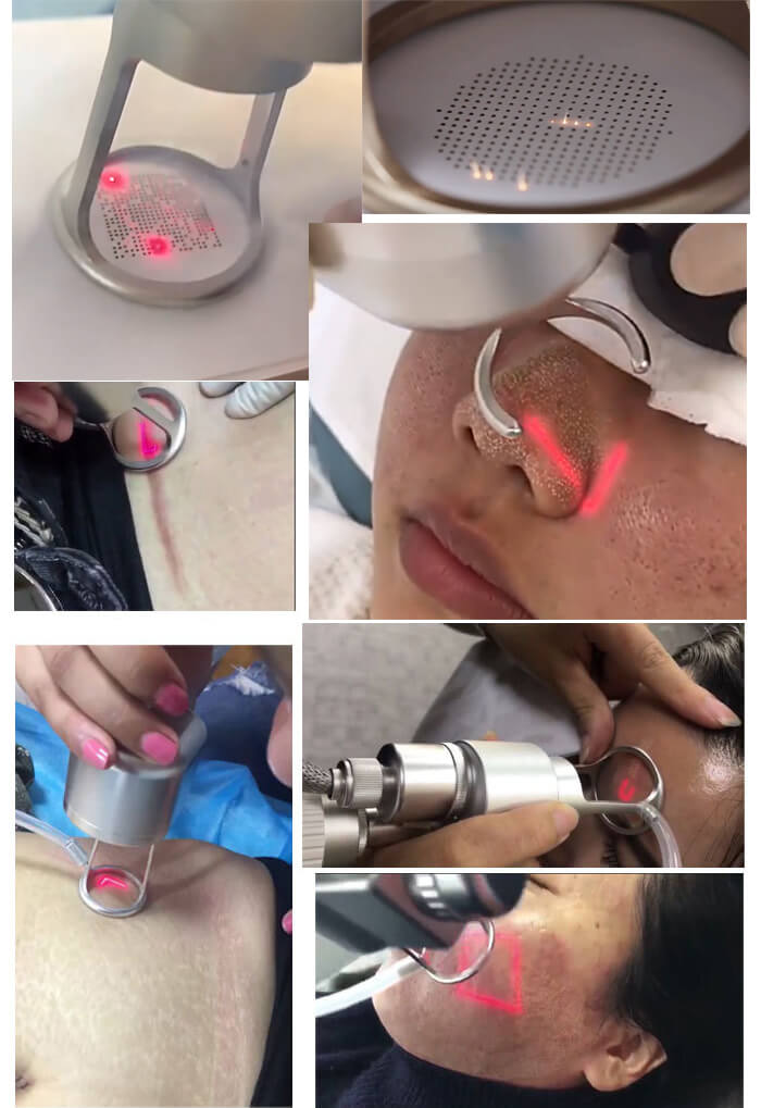 fractional laser machine