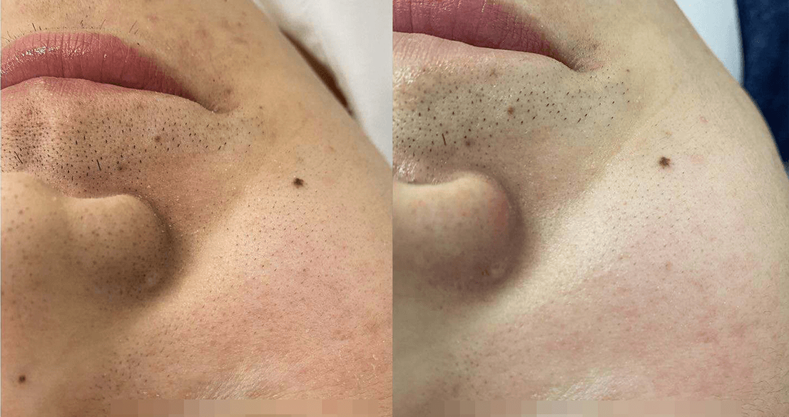hair removal