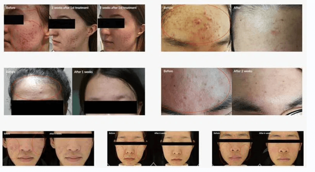 ozone plasma before after