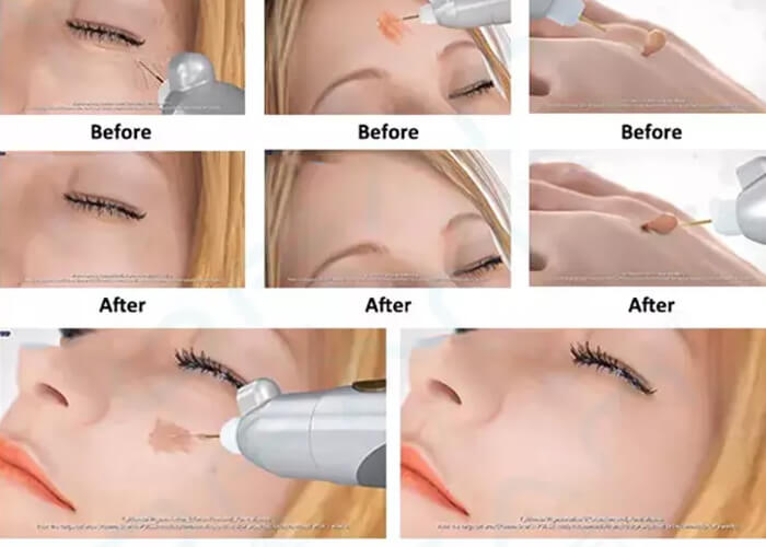 Fractional plasma lift appliance