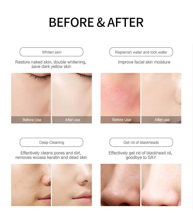 dermabrasion