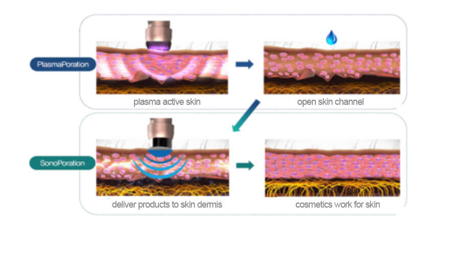 plasma lift therapy