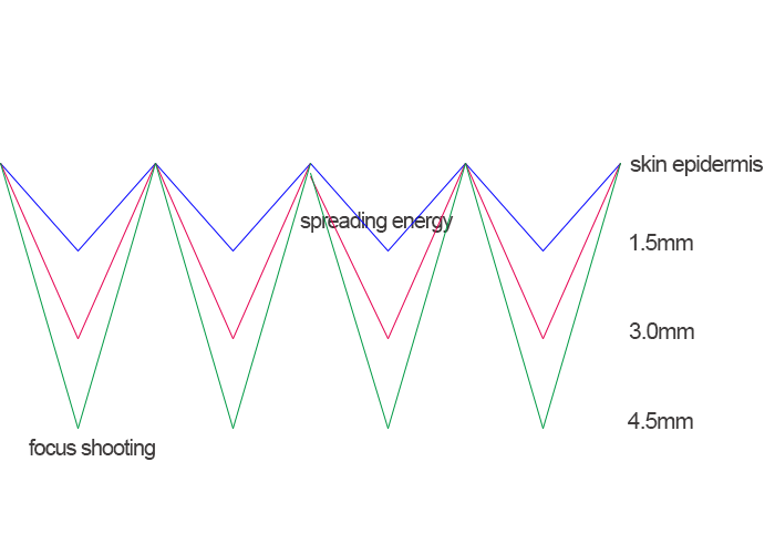 9D HIFU machine effective