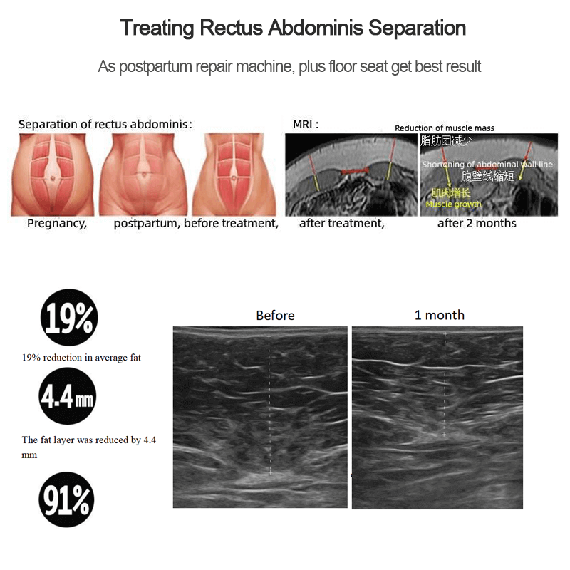 Hip and Postpartum Leakage repair