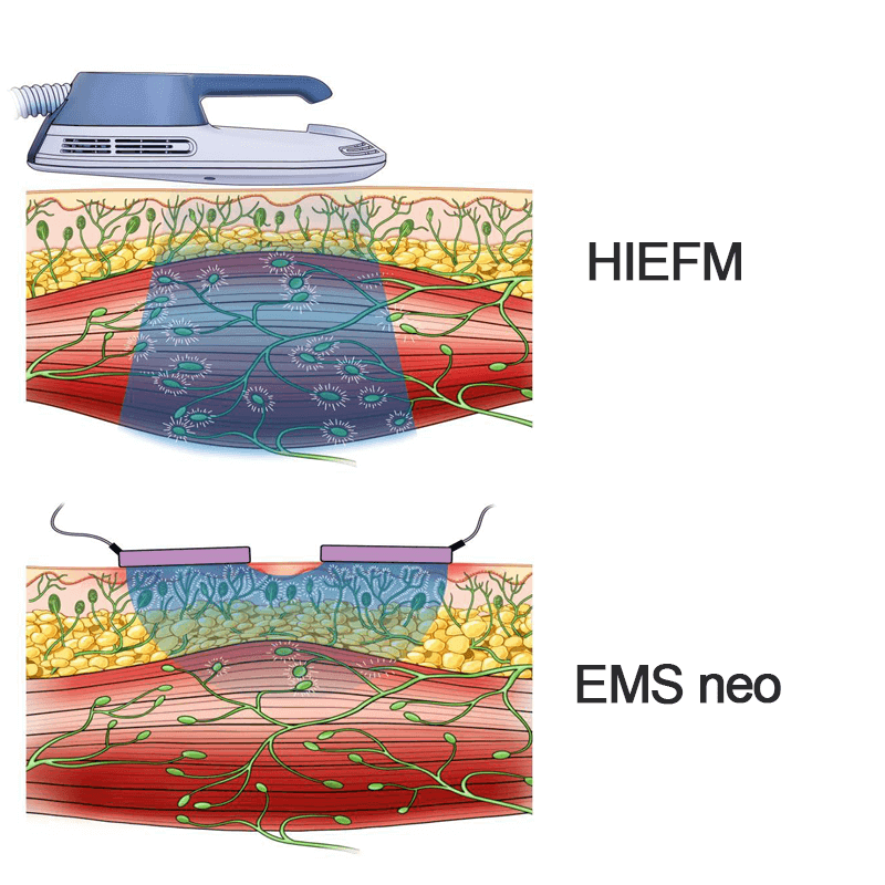 HIEFM