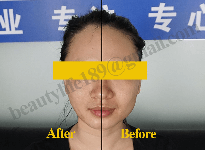 RF face lifting