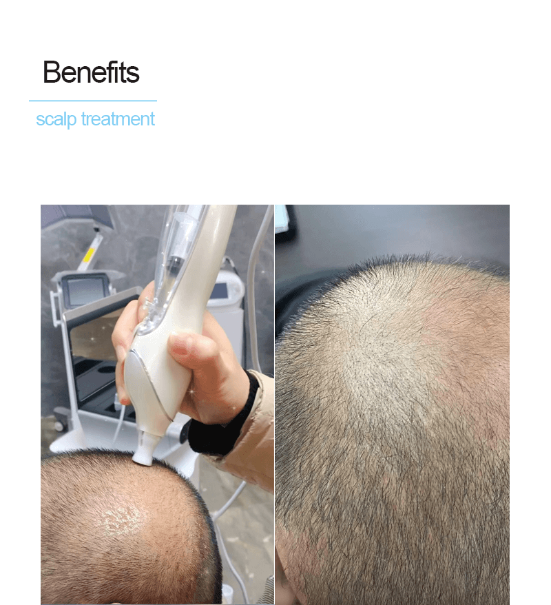 scalp injection machine