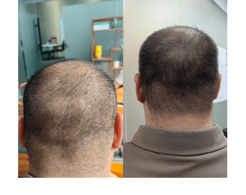scalp treatment machine