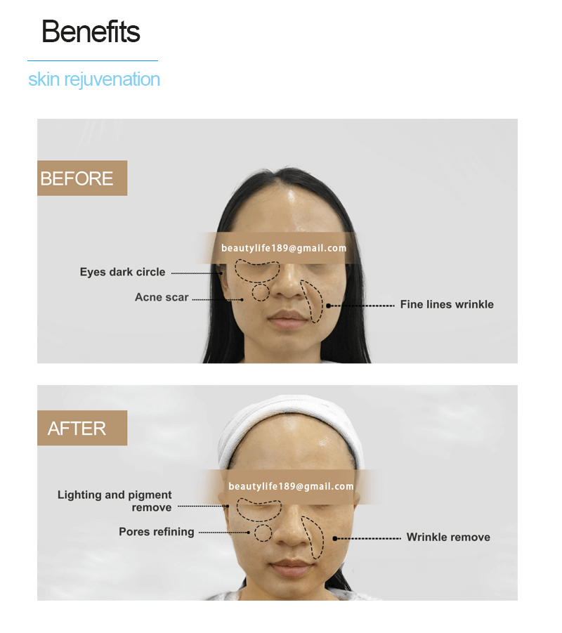 skin rejuvenation machine